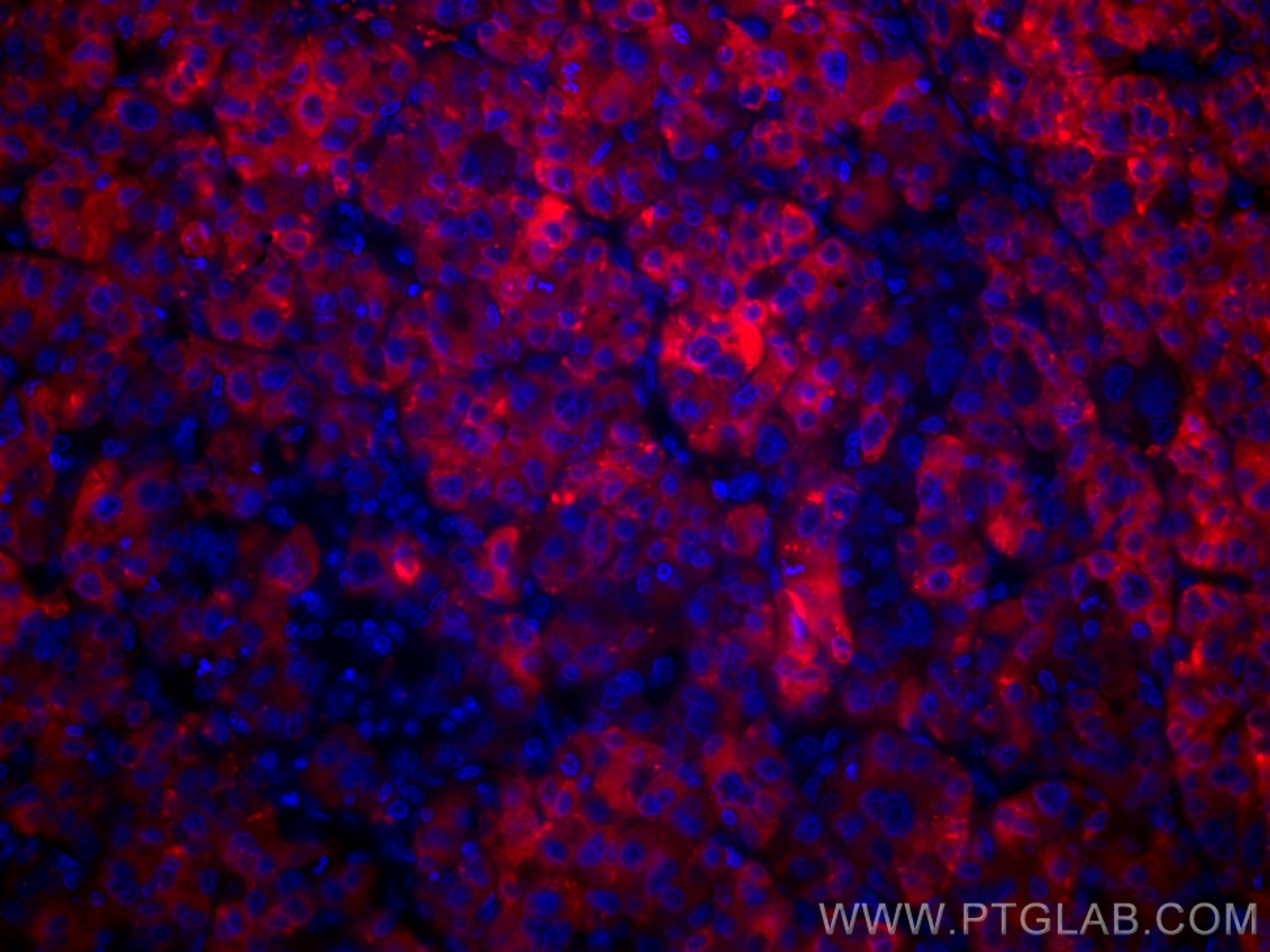 Immunofluorescence (IF) / fluorescent staining of human liver cancer tissue using CoraLite®594-conjugated RBP4 Monoclonal antibody (CL594-66104)