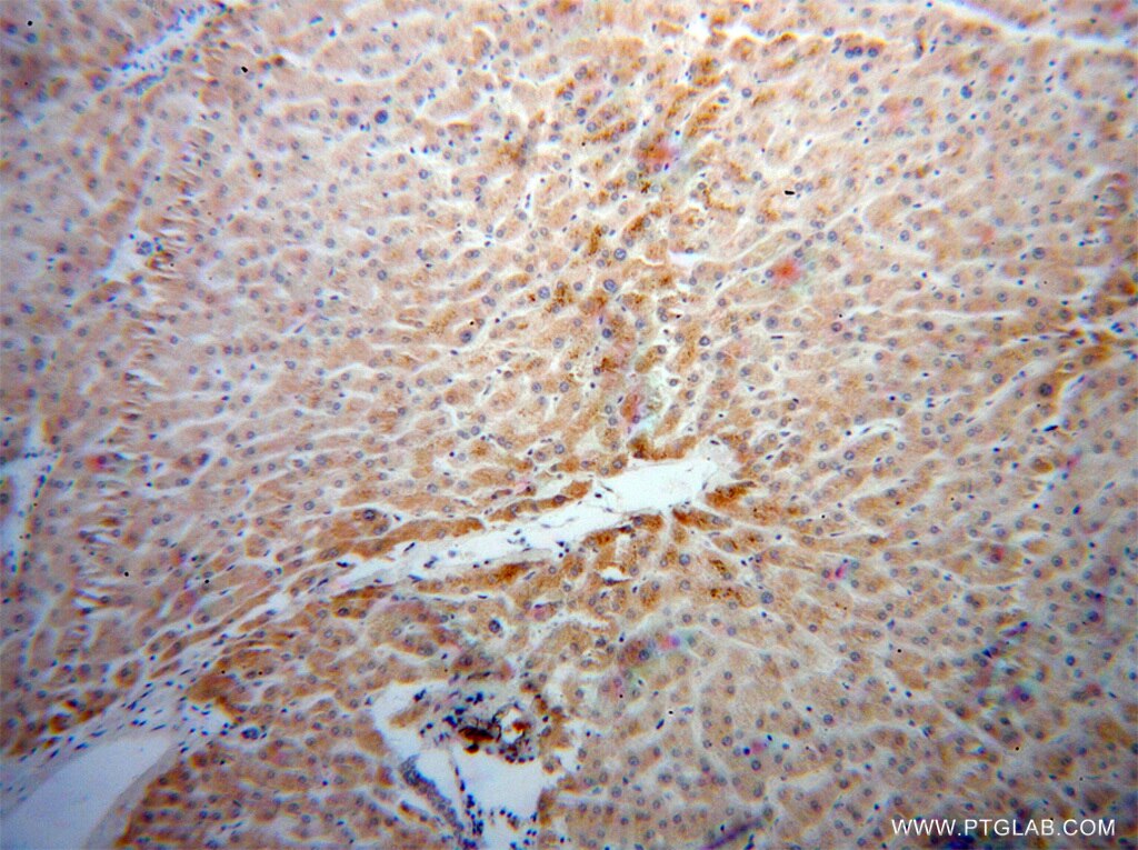 Immunohistochemistry (IHC) staining of human liver cancer tissue using RBP5 Polyclonal antibody (11843-1-AP)