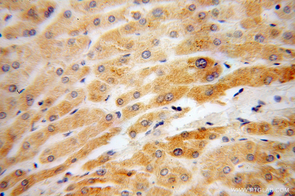Immunohistochemistry (IHC) staining of human liver cancer tissue using RBP5 Polyclonal antibody (11843-1-AP)