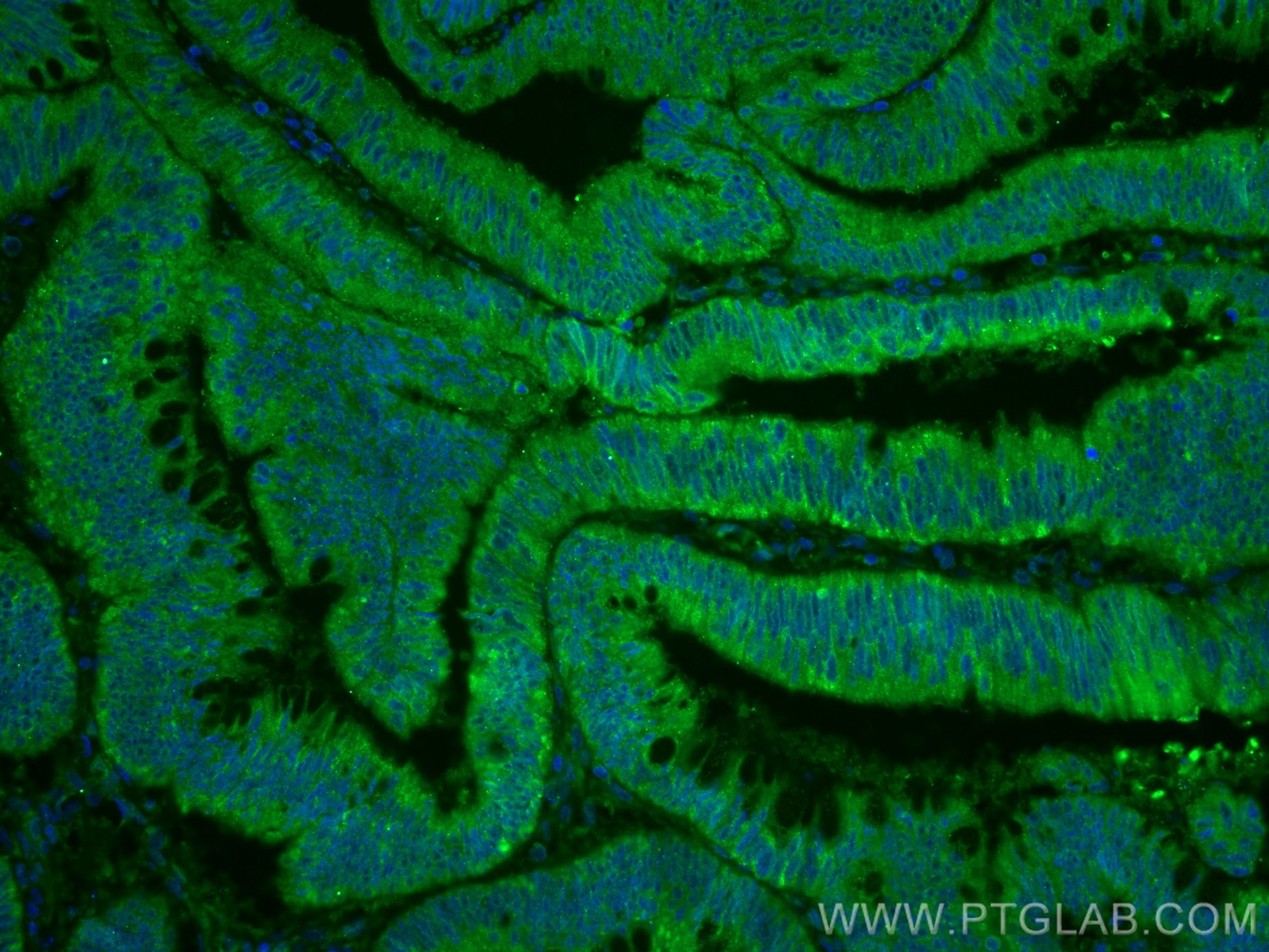 Immunofluorescence (IF) / fluorescent staining of human colon cancer tissue using RBP7 Polyclonal antibody (14541-1-AP)