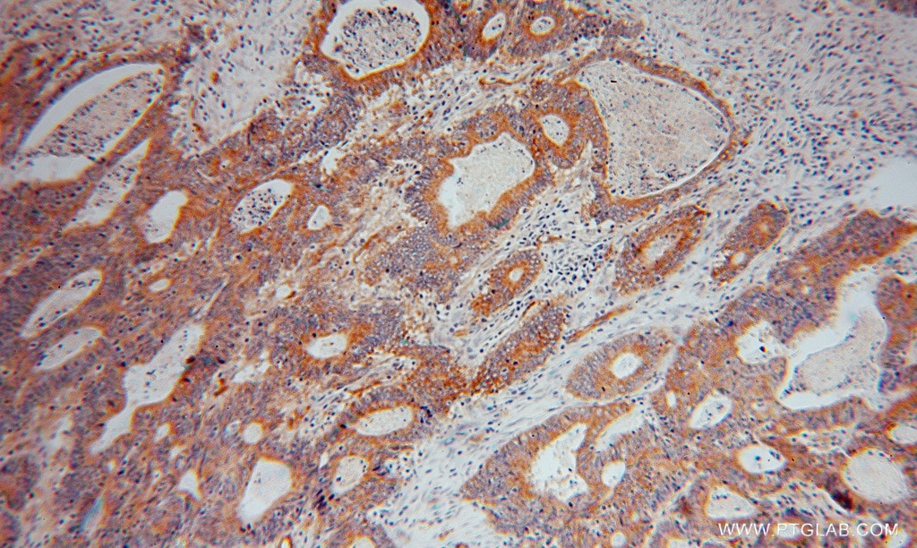 Immunohistochemistry (IHC) staining of human colon cancer tissue using RBP7 Polyclonal antibody (14541-1-AP)