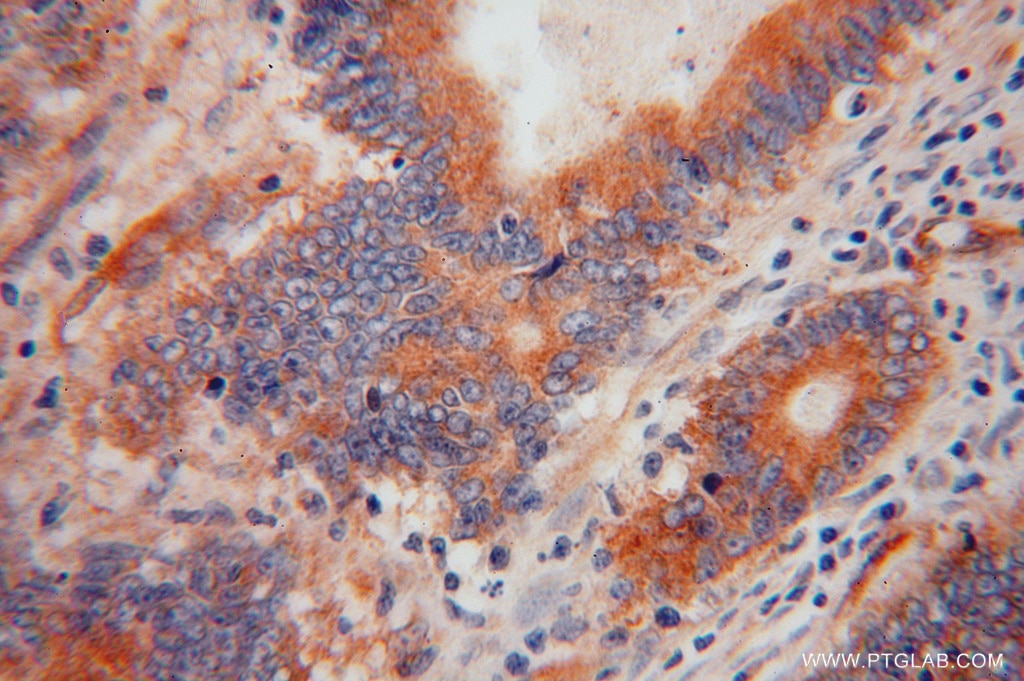Immunohistochemistry (IHC) staining of human colon cancer tissue using RBP7 Polyclonal antibody (14541-1-AP)