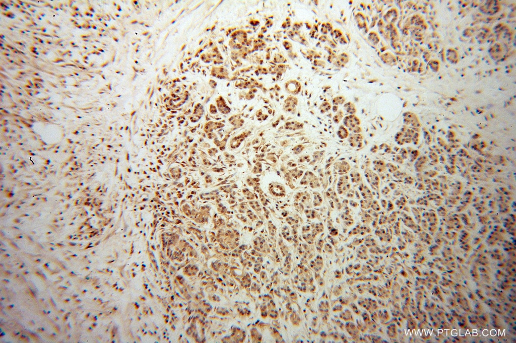 Immunohistochemistry (IHC) staining of human pancreas cancer tissue using RBPJ Polyclonal antibody (14613-1-AP)