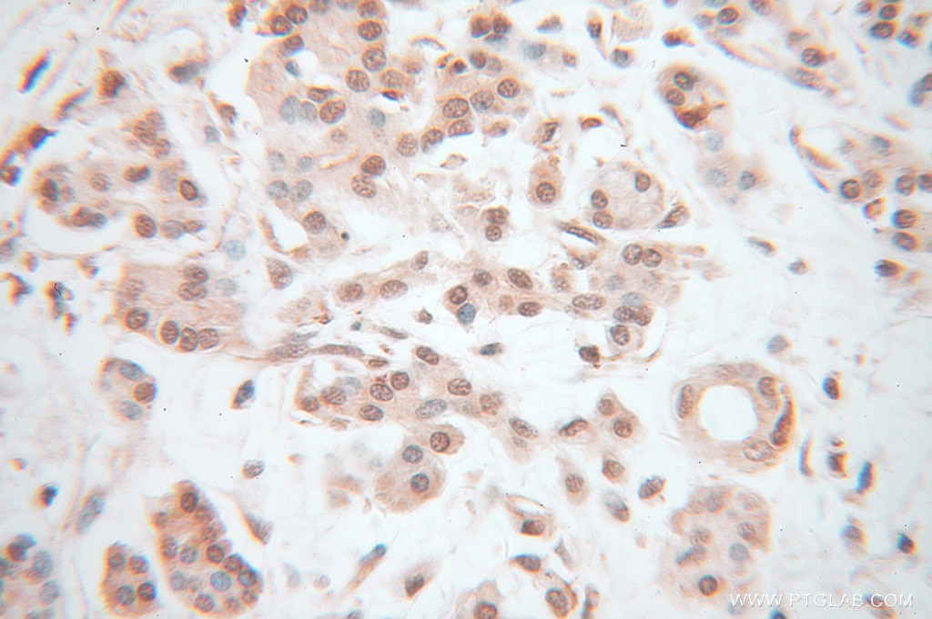 IHC staining of human pancreas cancer using 14613-1-AP