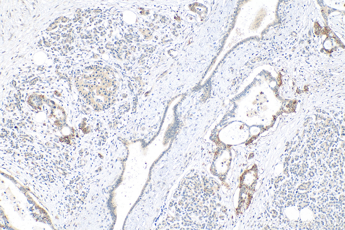 Immunohistochemistry (IHC) staining of human pancreas cancer tissue using RBPJ Polyclonal antibody (30044-1-AP)