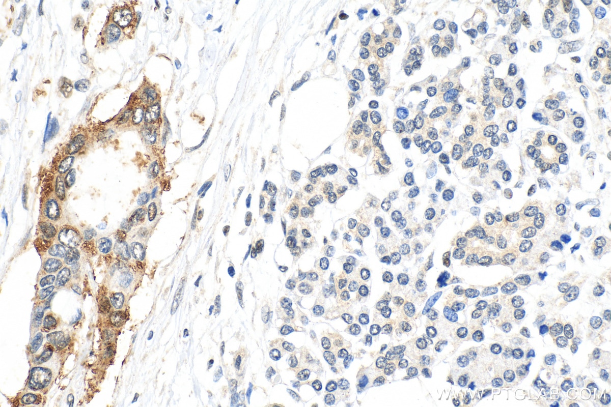 Immunohistochemistry (IHC) staining of human pancreas cancer tissue using RBPJ Polyclonal antibody (30044-1-AP)