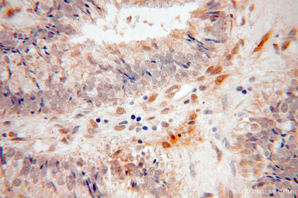 IHC staining of human ovary tumor using 15187-1-AP