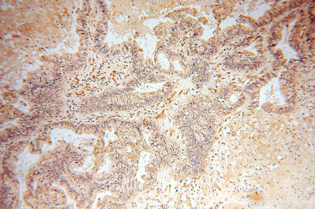 Immunohistochemistry (IHC) staining of human ovary tumor tissue using RBPMS Polyclonal antibody (15187-1-AP)