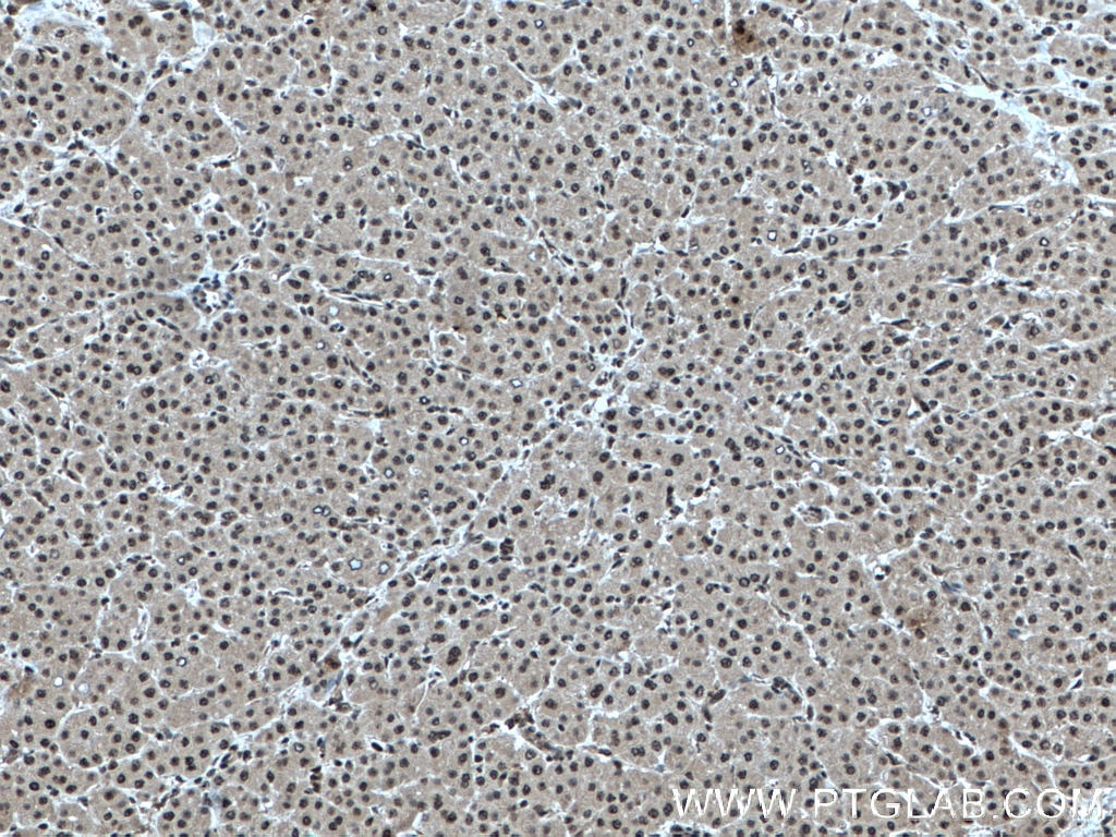 Immunohistochemistry (IHC) staining of human liver cancer tissue using RBX1 Monoclonal antibody (66716-1-Ig)