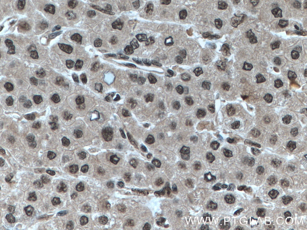 Immunohistochemistry (IHC) staining of human liver cancer tissue using RBX1 Monoclonal antibody (66716-1-Ig)