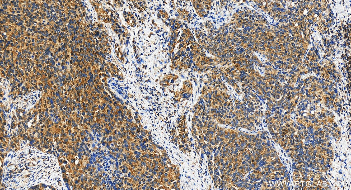 Immunohistochemistry (IHC) staining of human ovary cancer tissue using RC3H1 Polyclonal antibody (31234-1-AP)
