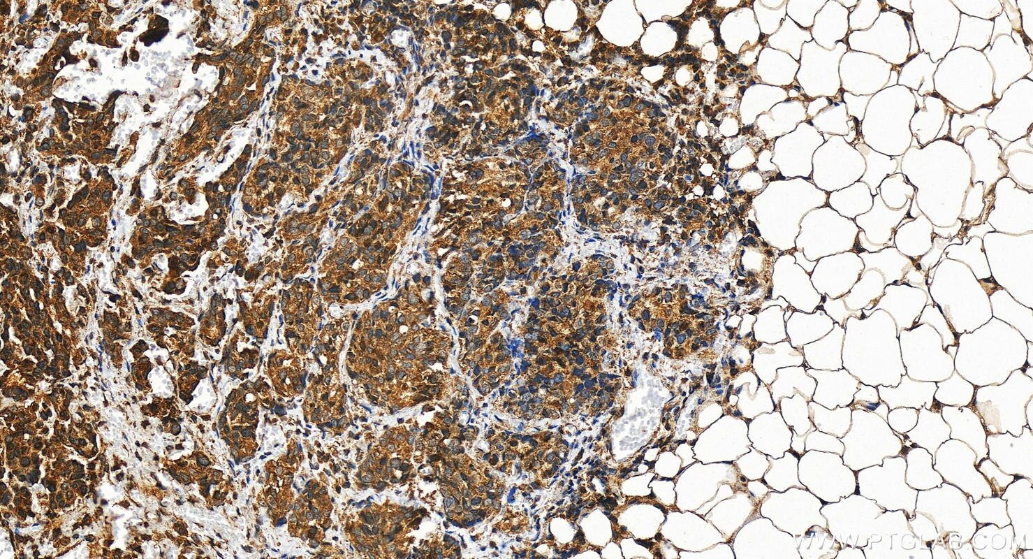 Immunohistochemistry (IHC) staining of human ovary cancer tissue using RC3H1 Polyclonal antibody (31234-1-AP)