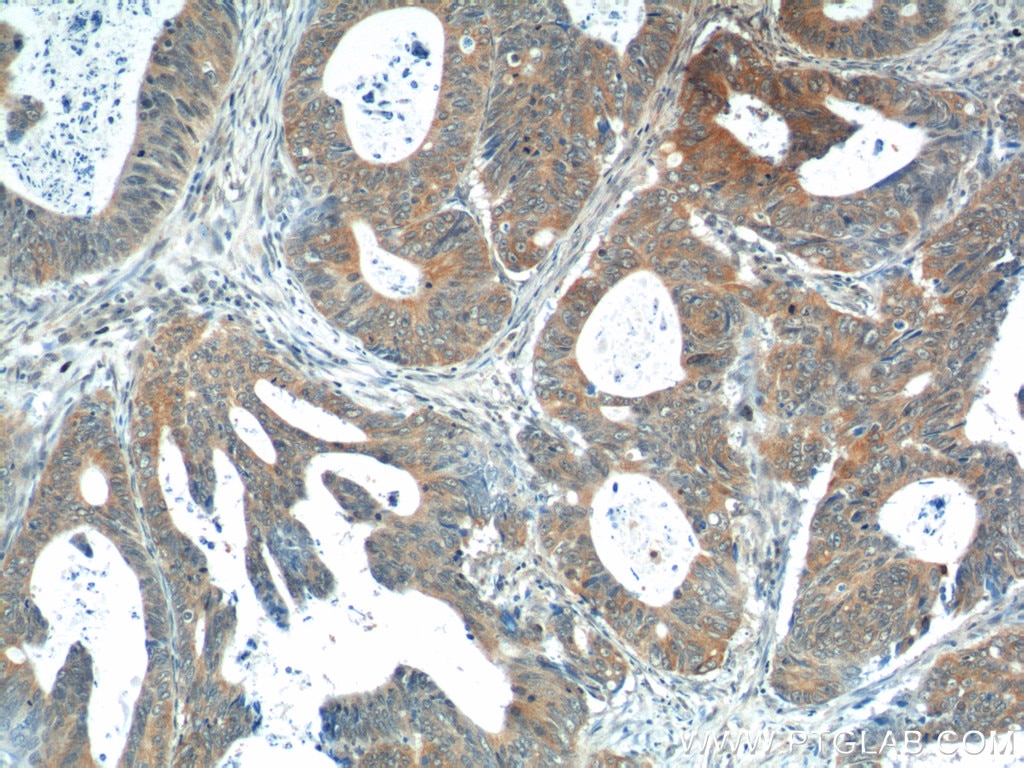 Immunohistochemistry (IHC) staining of human colon cancer tissue using Calcipressin 1 Polyclonal antibody (14869-1-AP)