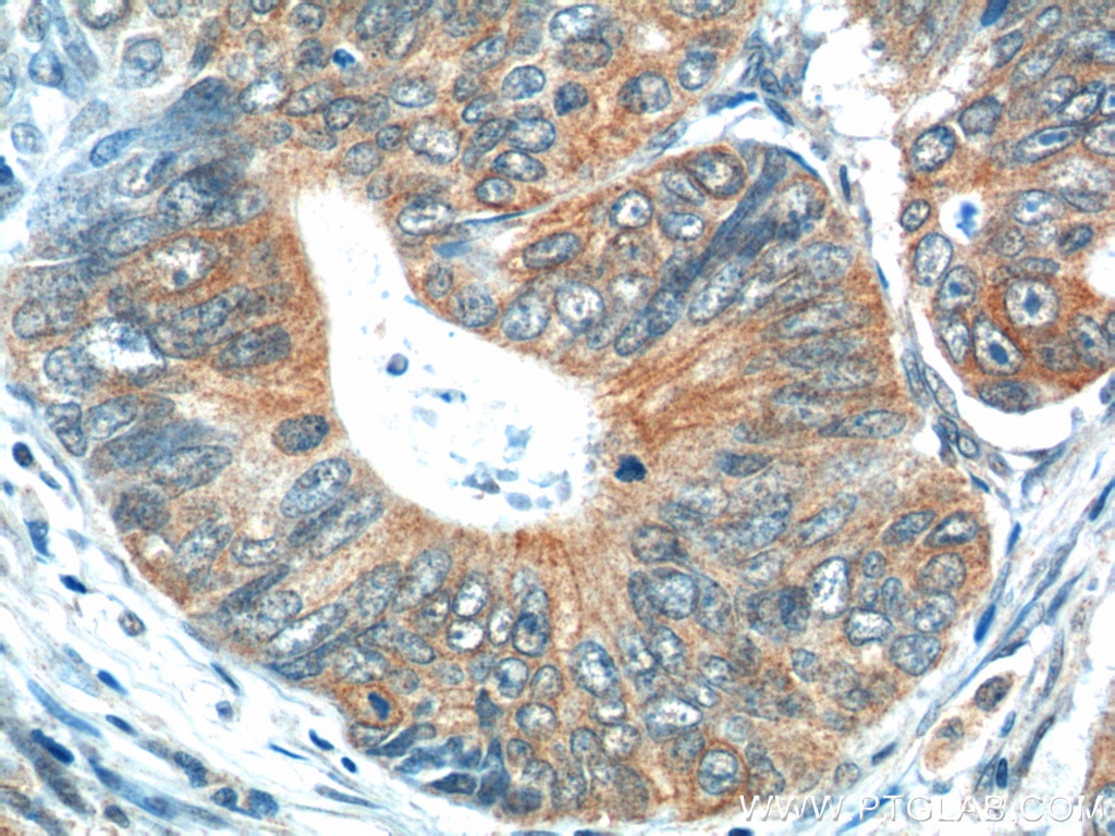 Immunohistochemistry (IHC) staining of human colon cancer tissue using Calcipressin 1 Polyclonal antibody (14869-1-AP)