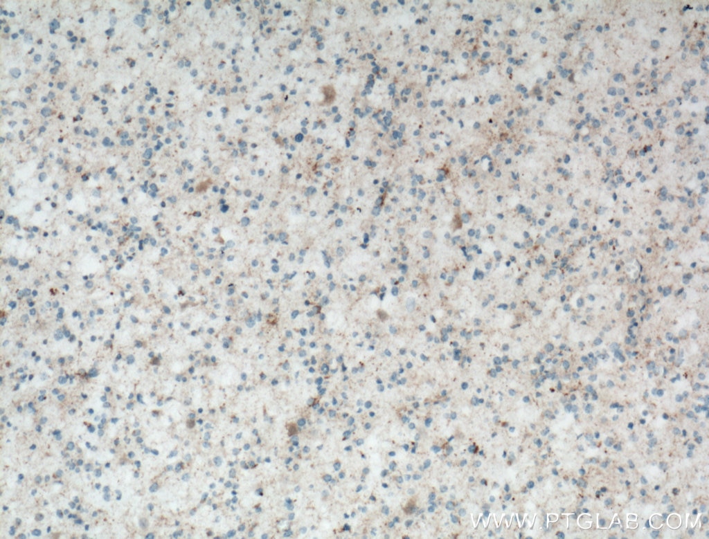 Immunohistochemistry (IHC) staining of human gliomas tissue using RCAN2 Polyclonal antibody (12900-1-AP)