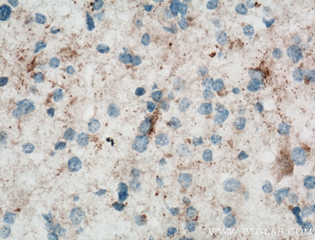 IHC staining of human gliomas using 12900-1-AP