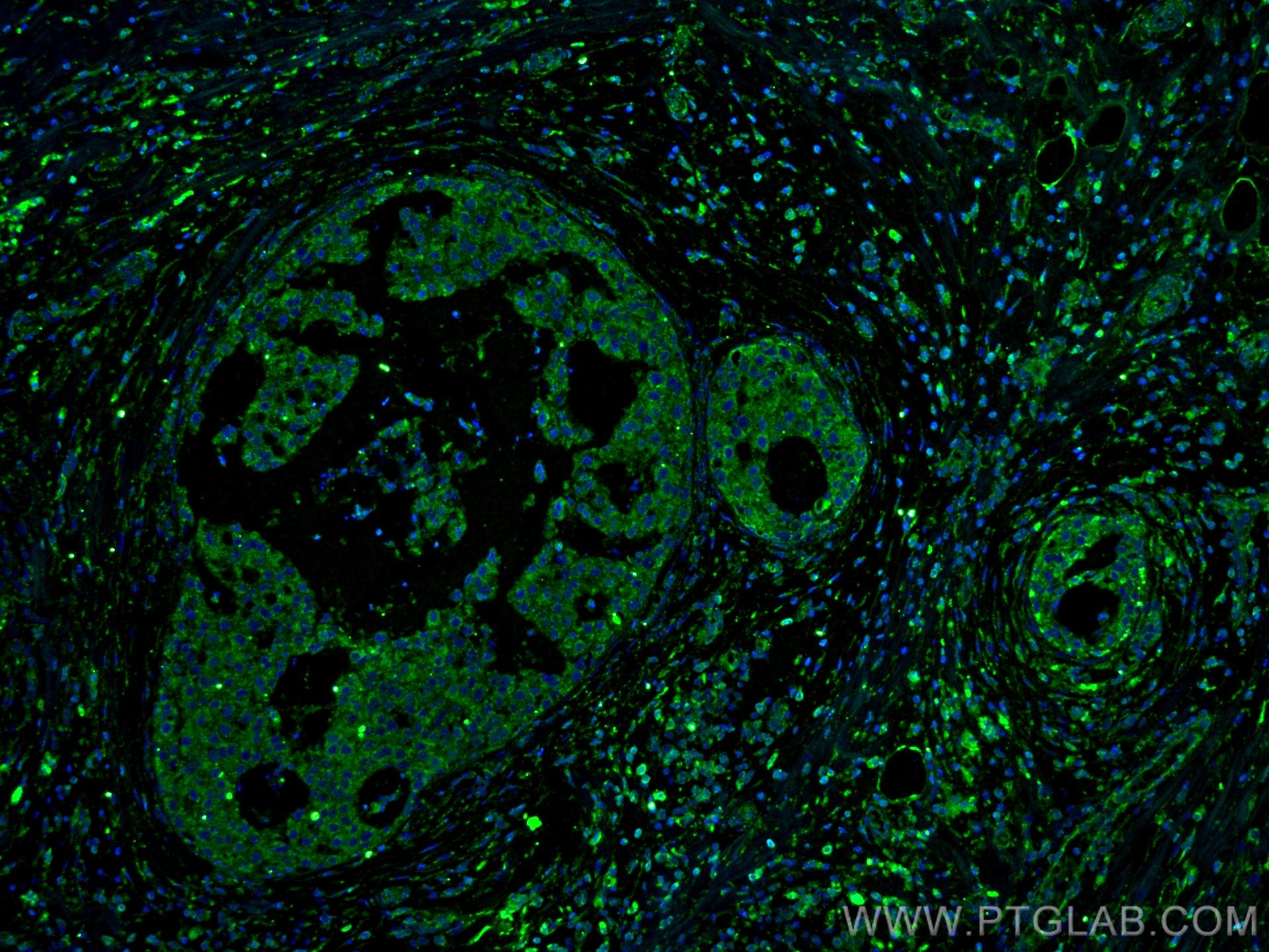Immunofluorescence (IF) / fluorescent staining of human breast cancer tissue using RCAS1 Monoclonal antibody (66170-1-Ig)