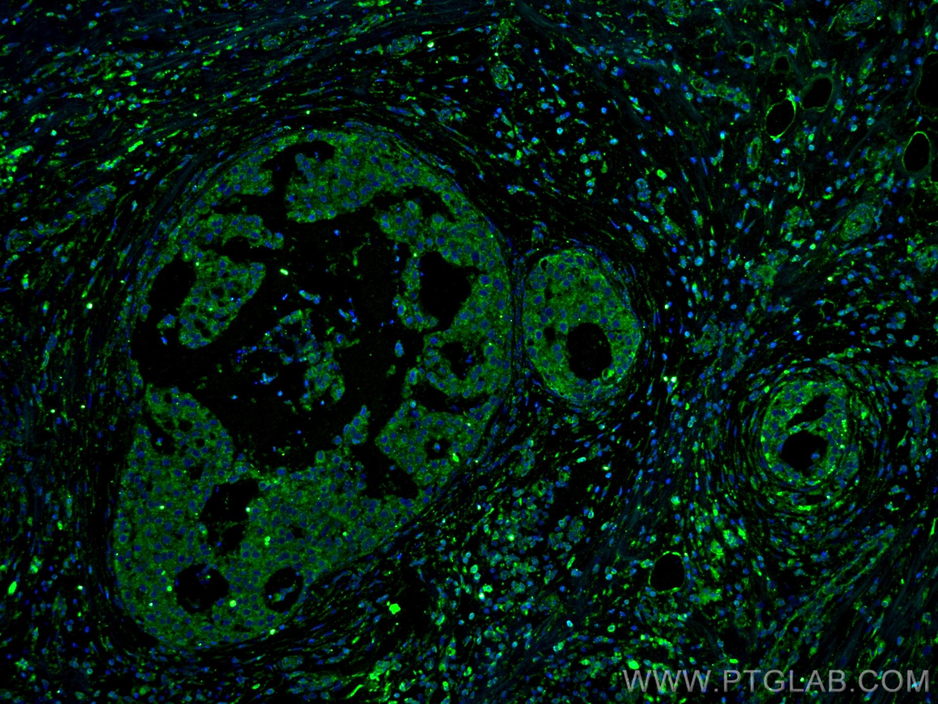 IF Staining of human breast cancer using 66170-1-Ig