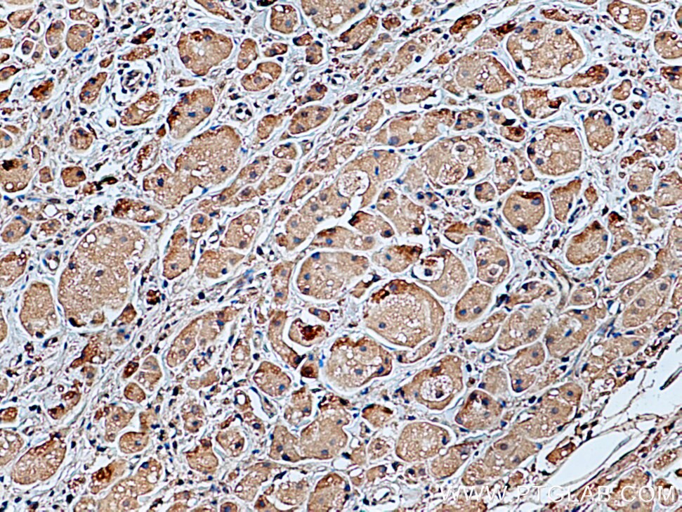 IHC staining of human breast cancer using 66170-1-Ig