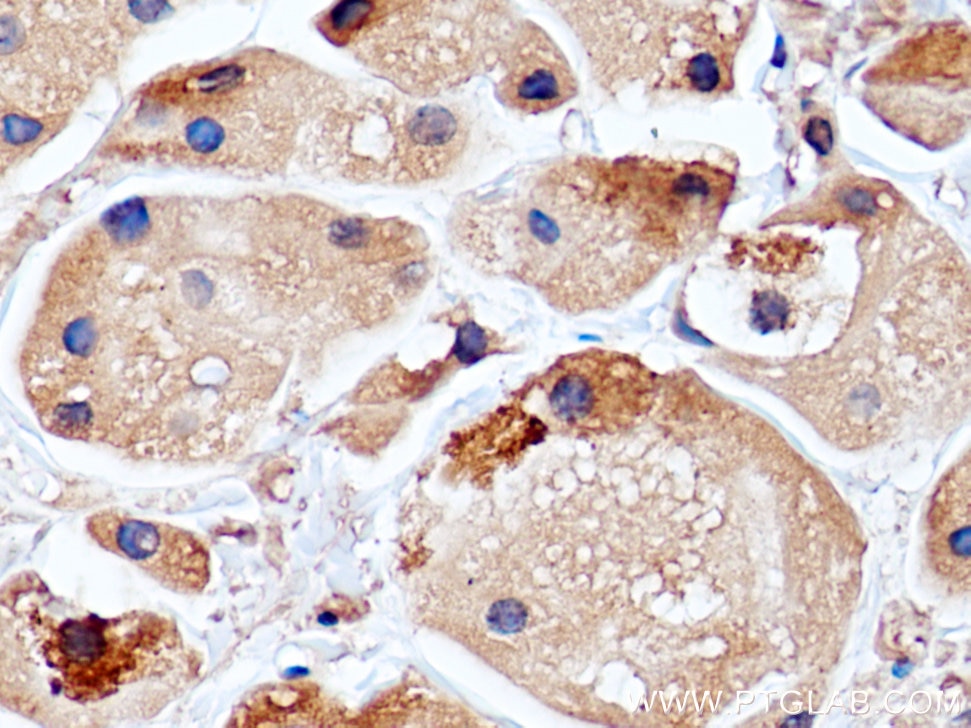 Immunohistochemistry (IHC) staining of human breast cancer tissue using RCAS1 Monoclonal antibody (66170-1-Ig)