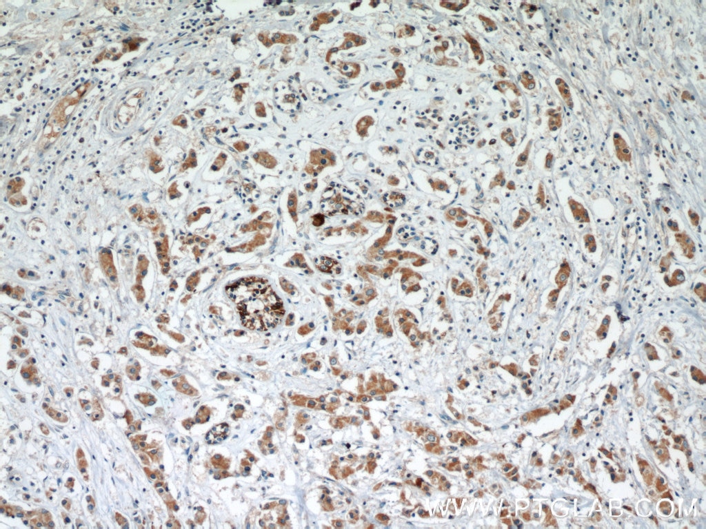 Immunohistochemistry (IHC) staining of human breast cancer tissue using RCAS1 Monoclonal antibody (66170-1-Ig)