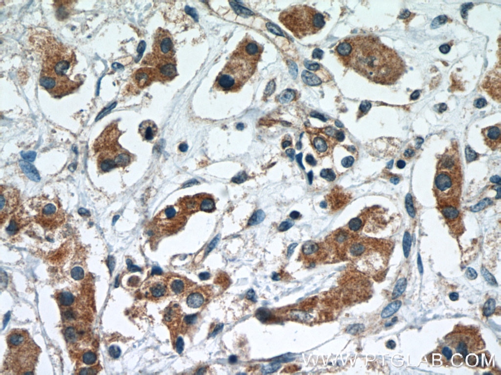 Immunohistochemistry (IHC) staining of human breast cancer tissue using RCAS1 Monoclonal antibody (66170-1-Ig)