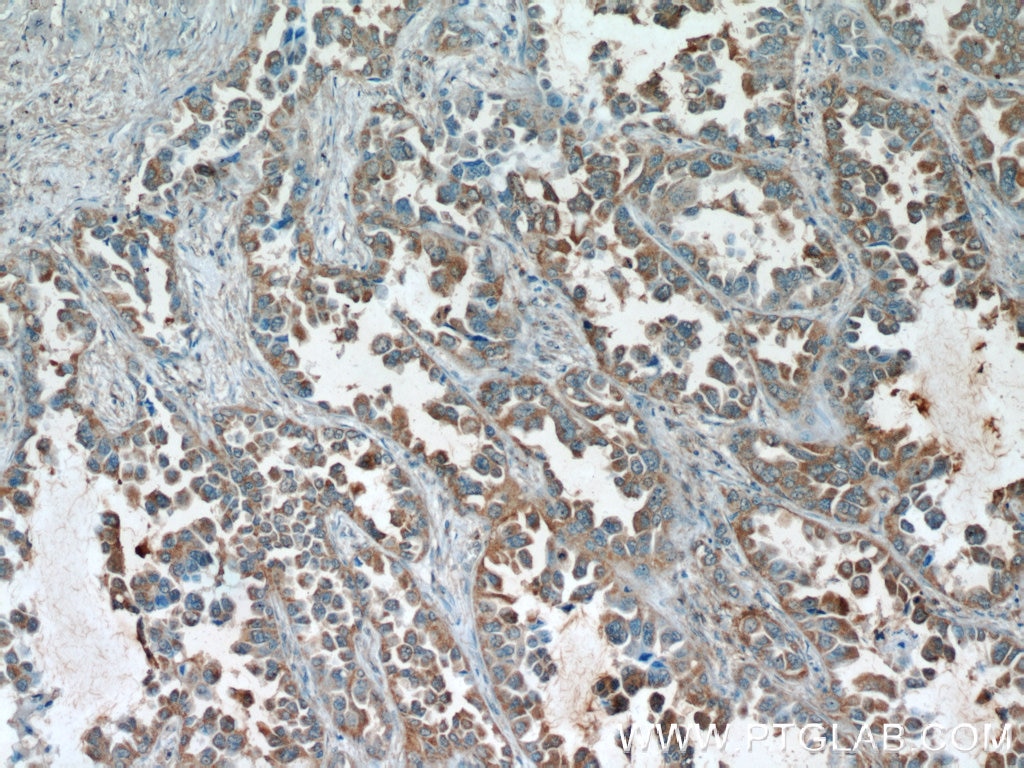 Immunohistochemistry (IHC) staining of human lung cancer tissue using RCAS1 Monoclonal antibody (66170-1-Ig)