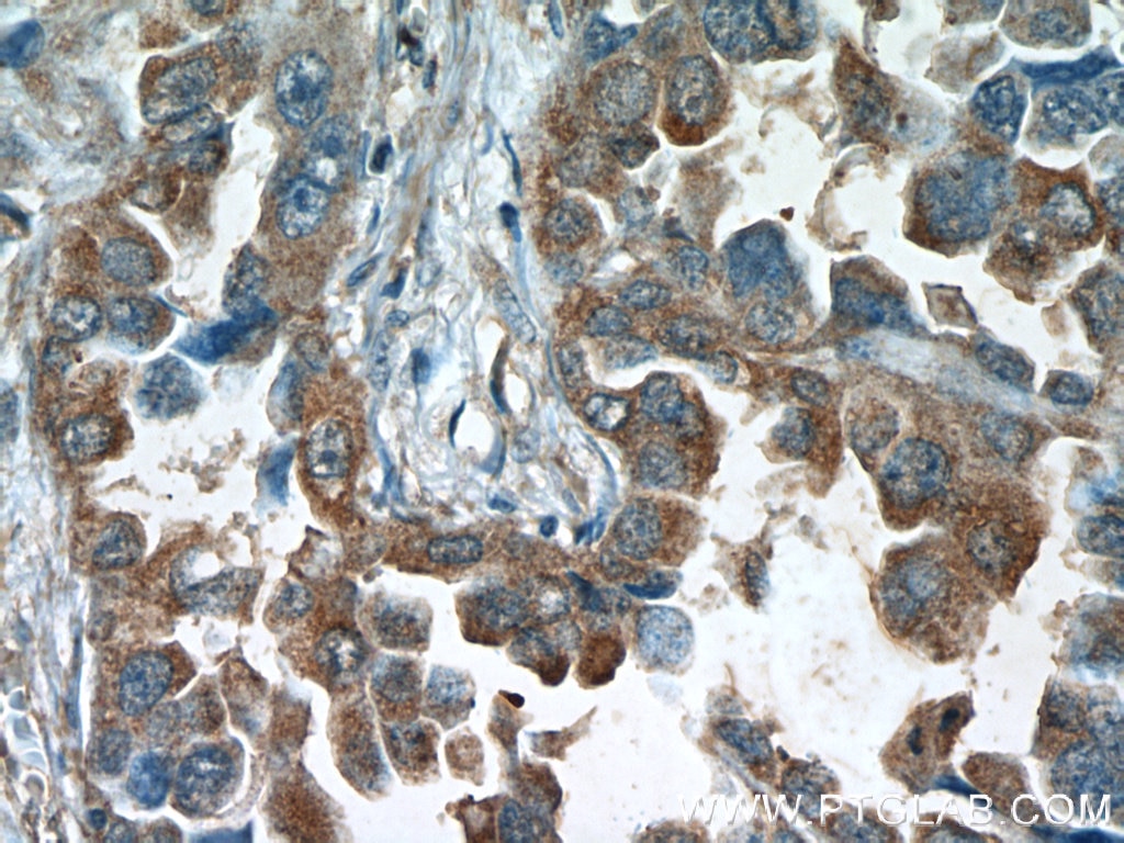 Immunohistochemistry (IHC) staining of human lung cancer tissue using RCAS1 Monoclonal antibody (66170-1-Ig)