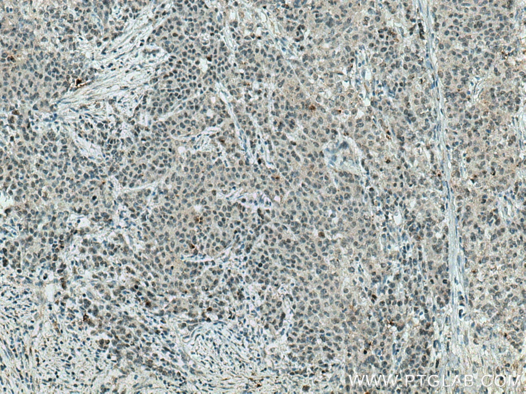 Immunohistochemistry (IHC) staining of human stomach cancer tissue using RCC1 Monoclonal antibody (67335-1-Ig)