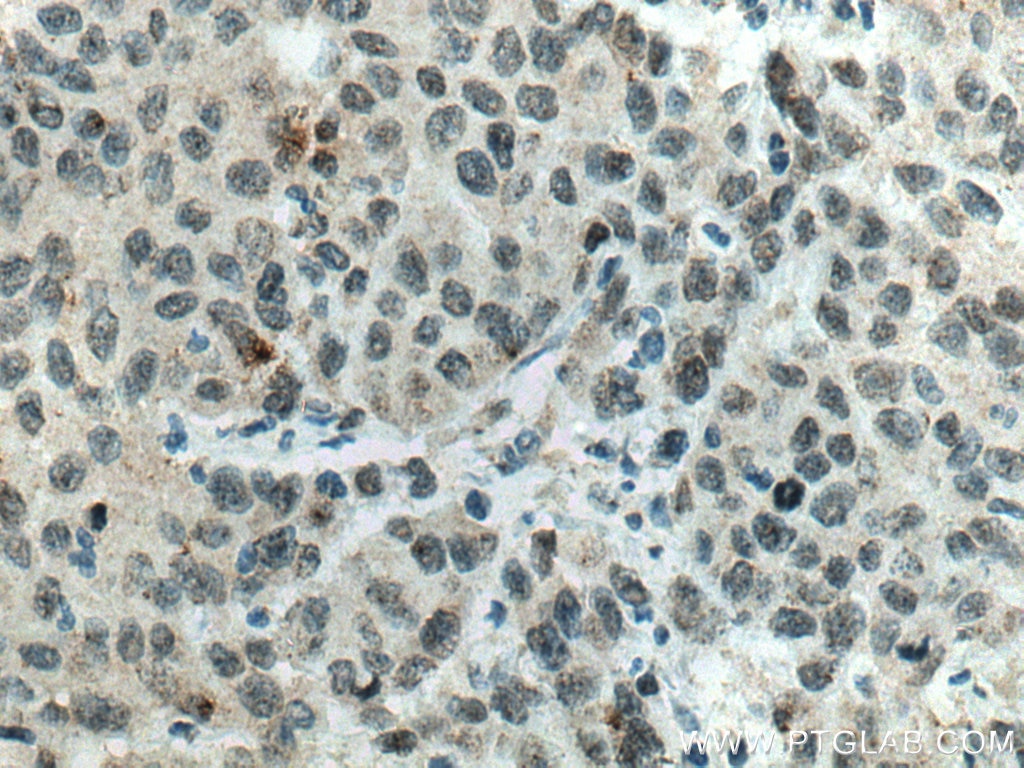 IHC staining of human stomach cancer using 67335-1-Ig