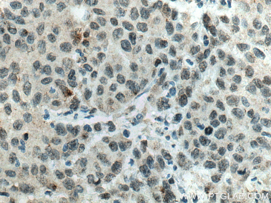 Immunohistochemistry (IHC) staining of human stomach cancer tissue using RCC1 Monoclonal antibody (67335-1-Ig)