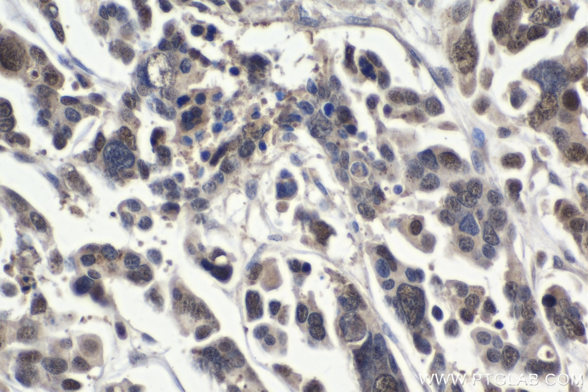 Immunohistochemistry (IHC) staining of human colon cancer tissue using RCC2 Polyclonal antibody (16755-1-AP)