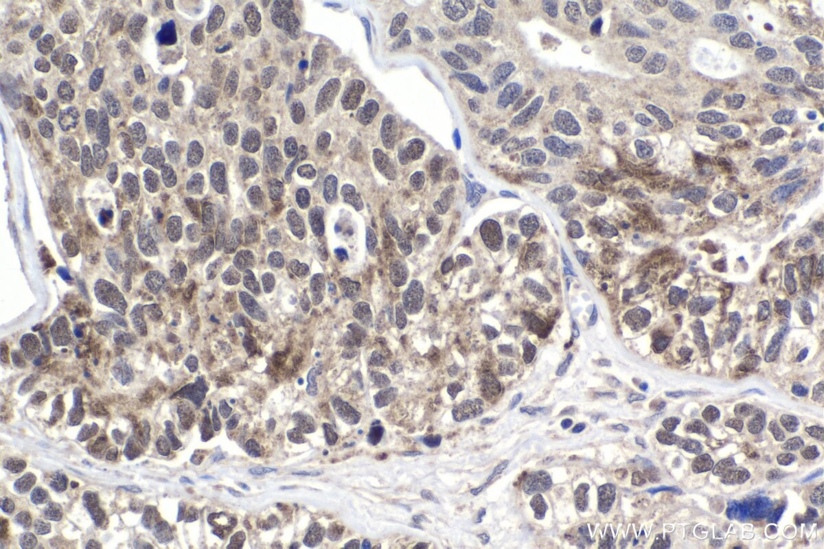 Immunohistochemistry (IHC) staining of human ovary tumor tissue using RCC2 Polyclonal antibody (16755-1-AP)