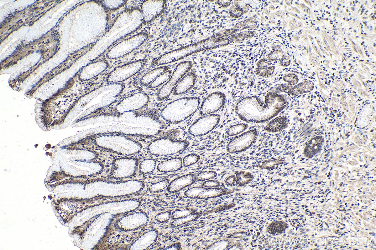 IHC staining of human stomach cancer using 16755-1-AP