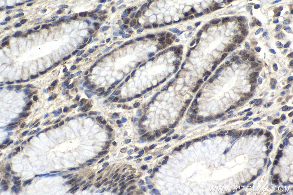 Immunohistochemistry (IHC) staining of human stomach cancer tissue using RCC2 Polyclonal antibody (16755-1-AP)