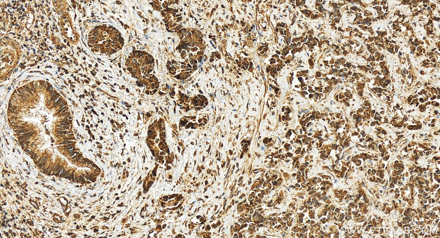 Immunohistochemistry (IHC) staining of human intrahepatic cholangiocarcinoma tissue using RCCD1 Polyclonal antibody (24446-1-AP)
