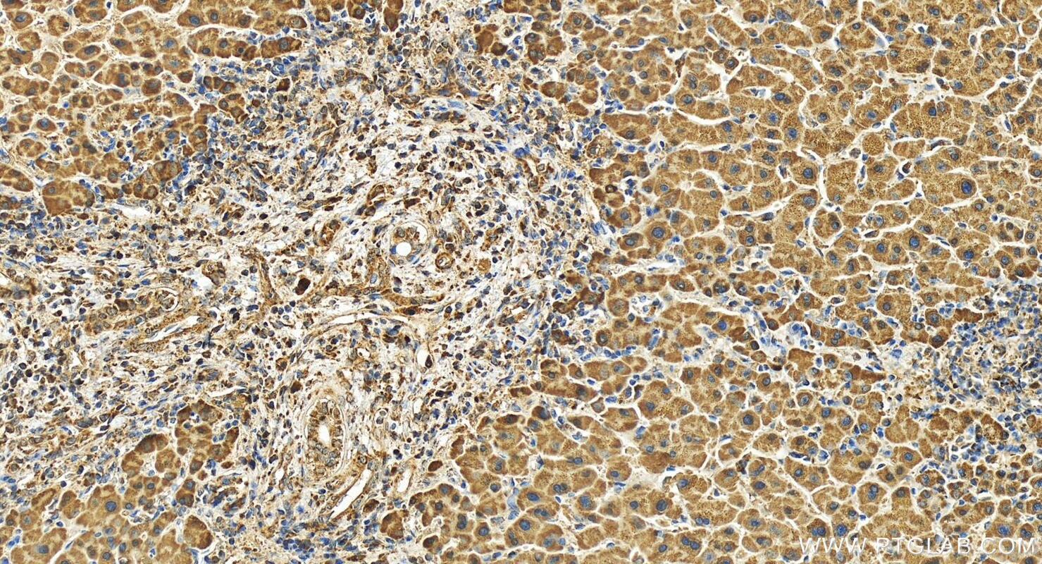 Immunohistochemistry (IHC) staining of human intrahepatic cholangiocarcinoma tissue using RCCD1 Polyclonal antibody (24446-1-AP)
