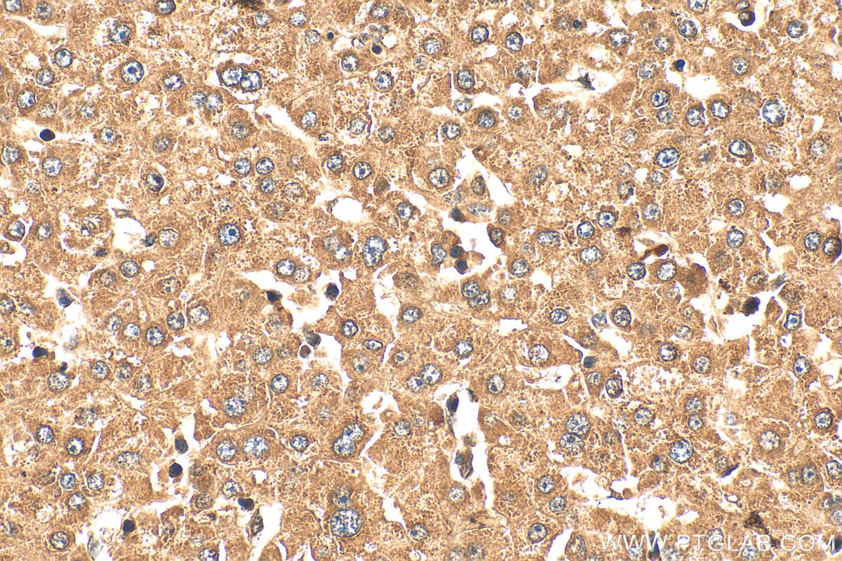 Immunohistochemical analysis of paraffin-embedded human liver cancer tissue slide using 24446-1-AP (RCCD1 antibody) at dilution of 1:200 (under 40x lens). Heat mediated antigen retrieval with Tris-EDTA buffer (pH 9.0). Immunohistochemistry (IHC) staining of human liver cancer tissue using RCCD1 Polyclonal antibody (24446-1-AP)
