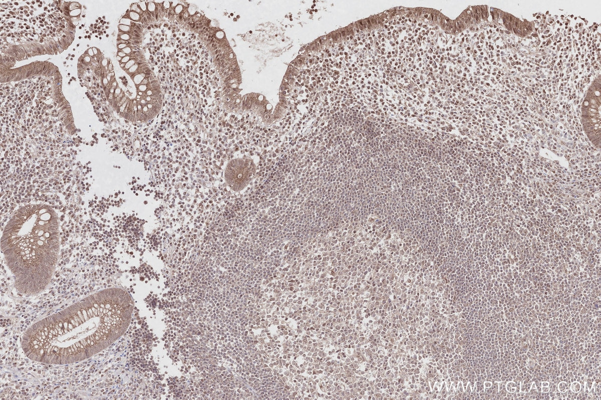 Immunohistochemistry (IHC) staining of human appendicitis tissue using Pirh2 Polyclonal antibody (13820-1-AP)