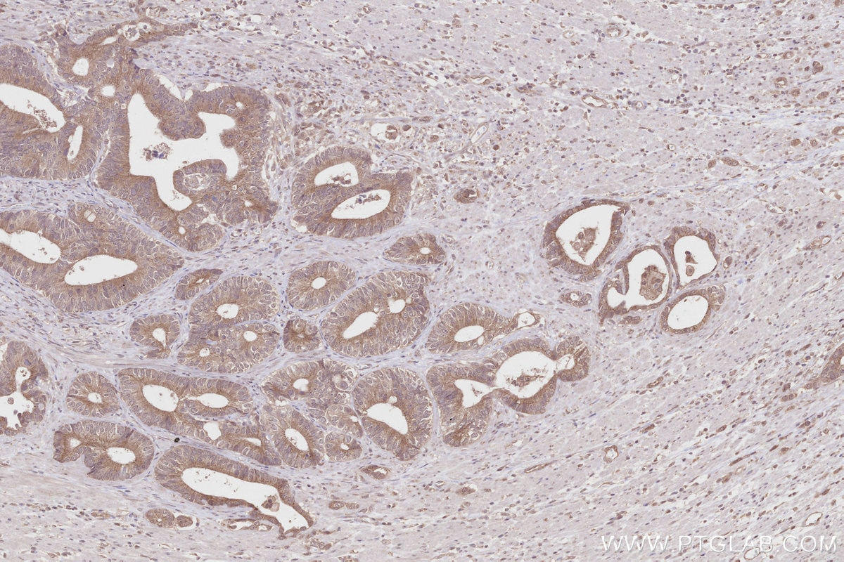 Immunohistochemistry (IHC) staining of human rectal cancer tissue using Pirh2 Polyclonal antibody (13820-1-AP)