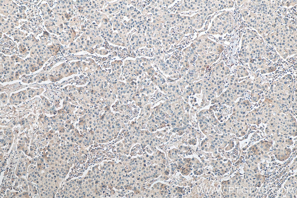 Immunohistochemistry (IHC) staining of human breast cancer tissue using RCHY1 Monoclonal antibody (67856-1-Ig)