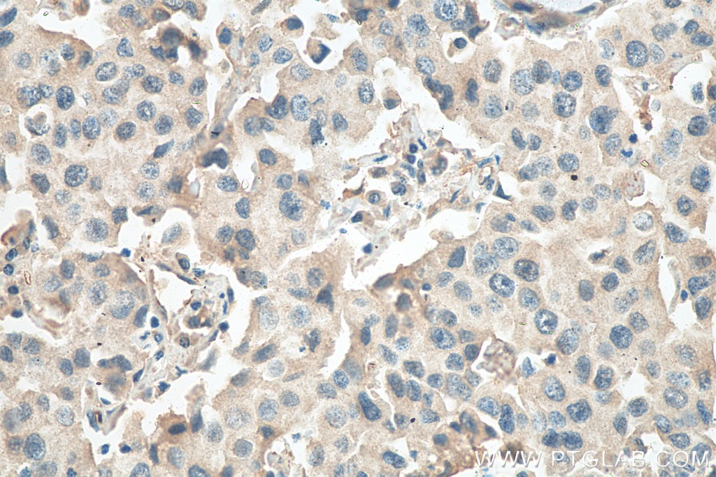 Immunohistochemistry (IHC) staining of human breast cancer tissue using RCHY1 Monoclonal antibody (67856-1-Ig)