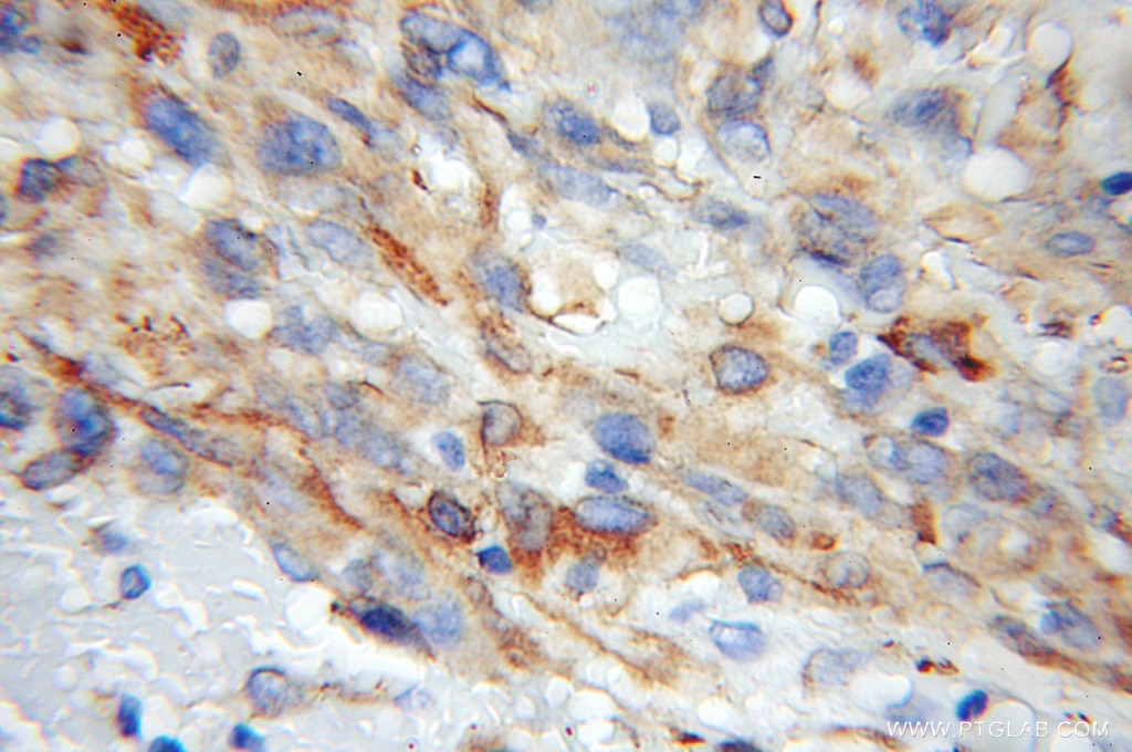 Immunohistochemistry (IHC) staining of human gliomas tissue using RCN2 Polyclonal antibody (10193-2-AP)