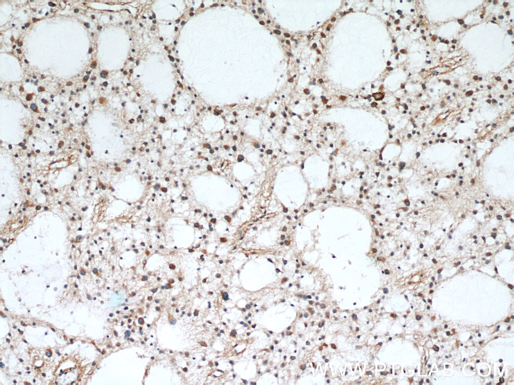 Immunohistochemistry (IHC) staining of human gliomas tissue using RCN2 Polyclonal antibody (10193-2-AP)