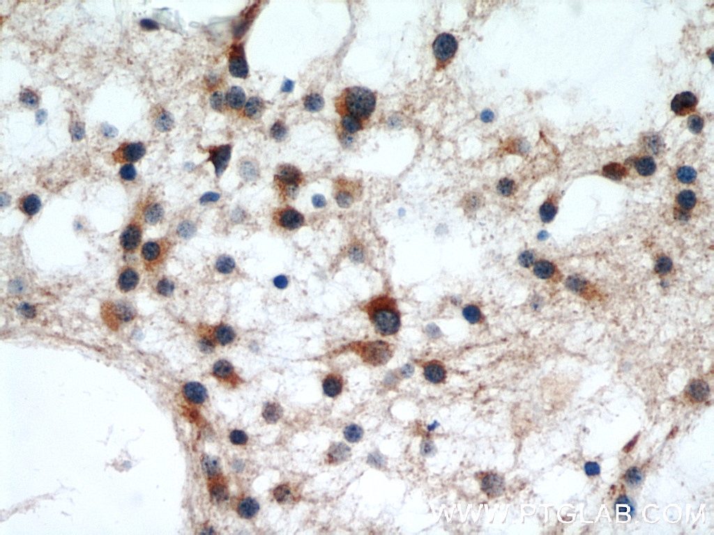 Immunohistochemistry (IHC) staining of human gliomas tissue using RCN2 Polyclonal antibody (10193-2-AP)