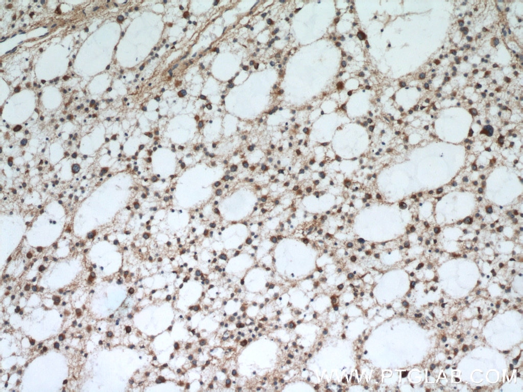 Immunohistochemistry (IHC) staining of human gliomas tissue using RCN2 Polyclonal antibody (10193-2-AP)