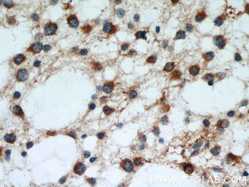 Immunohistochemistry (IHC) staining of human gliomas tissue using RCN2 Polyclonal antibody (10193-2-AP)