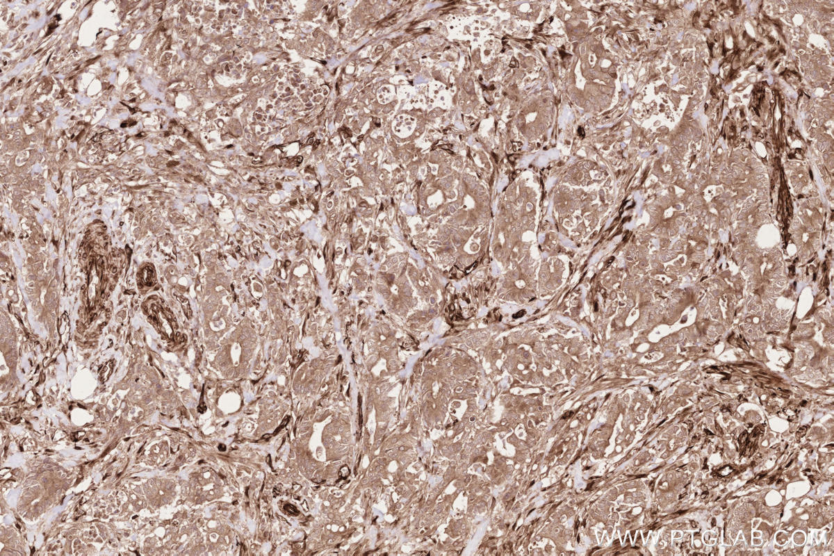 IHC staining of human rectal cancer using 14855-1-AP Immunohistochemistry (IHC) staining of human rectal cancer tissue using RD3 Polyclonal antibody (14855-1-AP)