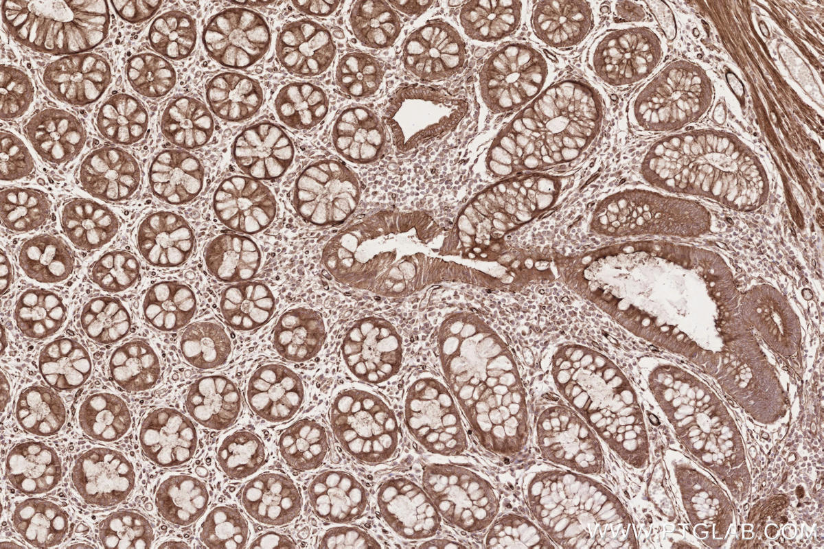 IHC staining of human rectal cancer using 14855-1-AP Immunohistochemistry (IHC) staining of human rectal cancer tissue using RD3 Polyclonal antibody (14855-1-AP)