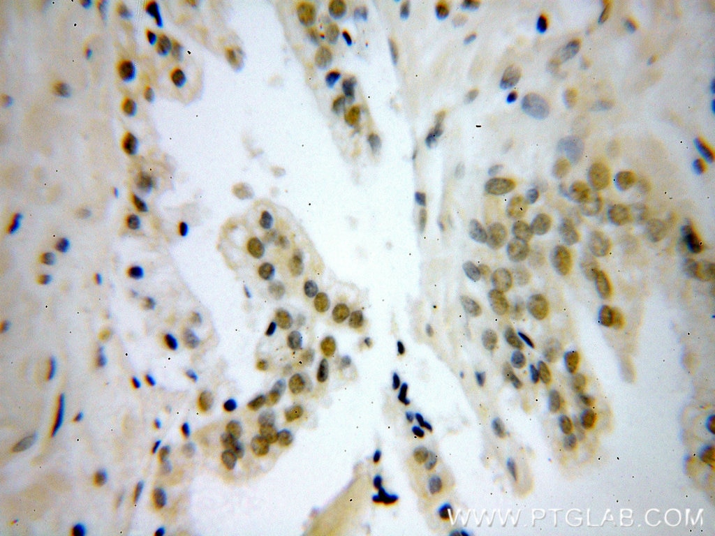 Immunohistochemistry (IHC) staining of human prostate cancer tissue using NELFE Polyclonal antibody (10705-1-AP)